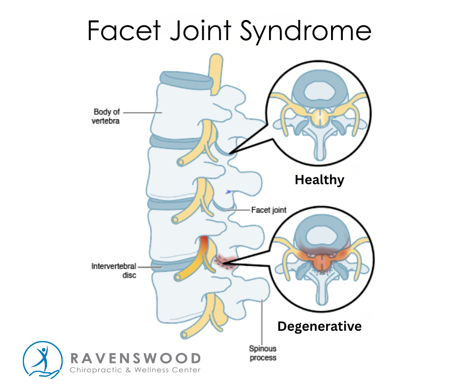 Say Goodbye to Facet Syndrome with Revolutionary Spinal Decompression ...